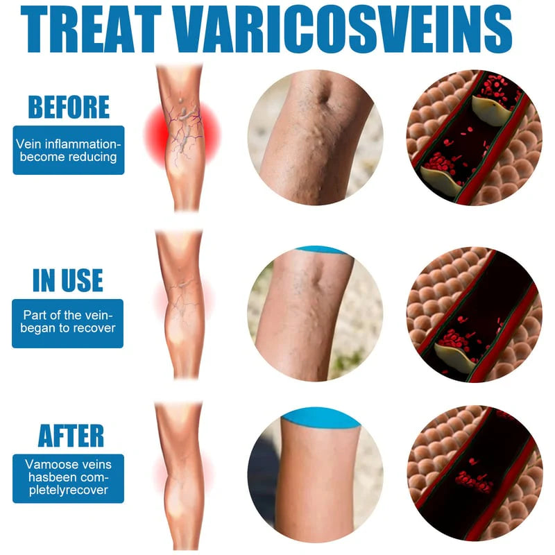 Varicose Veins Spray